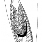 Lesión de la unión miotendinosa distal (fascia posterior)