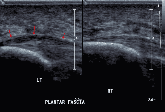 Imagen ecográfica que muestra un aumento de señal hipoecogénica a nivel de la inserción de la fascia plantar en la tuberosidad medial del calcáneo, compatible con inflamación de la fascia plantar